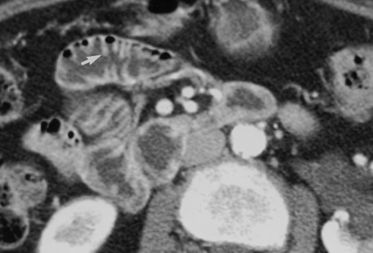 Bowel Wall Thickening 