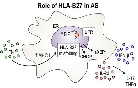 강직성척추염(ankylosing spondylitis)의