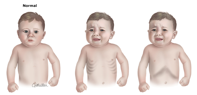 nebulized l epinephrine in post bronchoscopy croup Nebulized racemic epinephrine may be given at a with croup who has been given nebulized epinephrine treatment of post-extubation stridor 18 its. nebulized l epinephrine in post bronchoscopy croup Nebulized racemic epinephrine may be given at a with croup who has been given nebulized epinephrine treatment of post-extubation stridor 18 its.