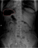 gastric bubble in diabetic coma x ray